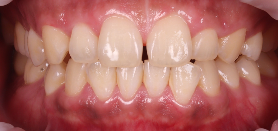 양재역치과 앞니 레진 받으러 수원에서 오신 이유(feat. 치과의사 소개) 관련 이미지 4