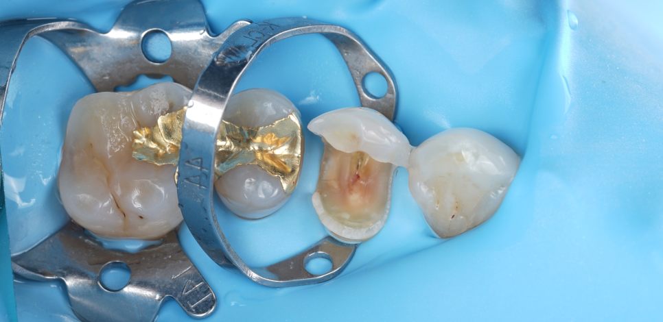 교대치과 신경치료 후 크라운 안 하고 오버레이로 보존 관련 이미지 10