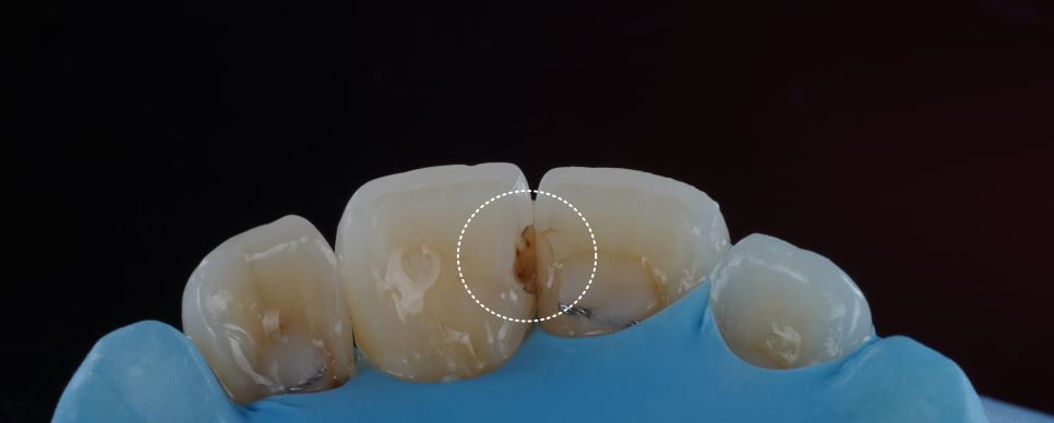 고속터미널역치과 레진치료 처음부터 잘 받아야 하는 이유 관련 이미지 6