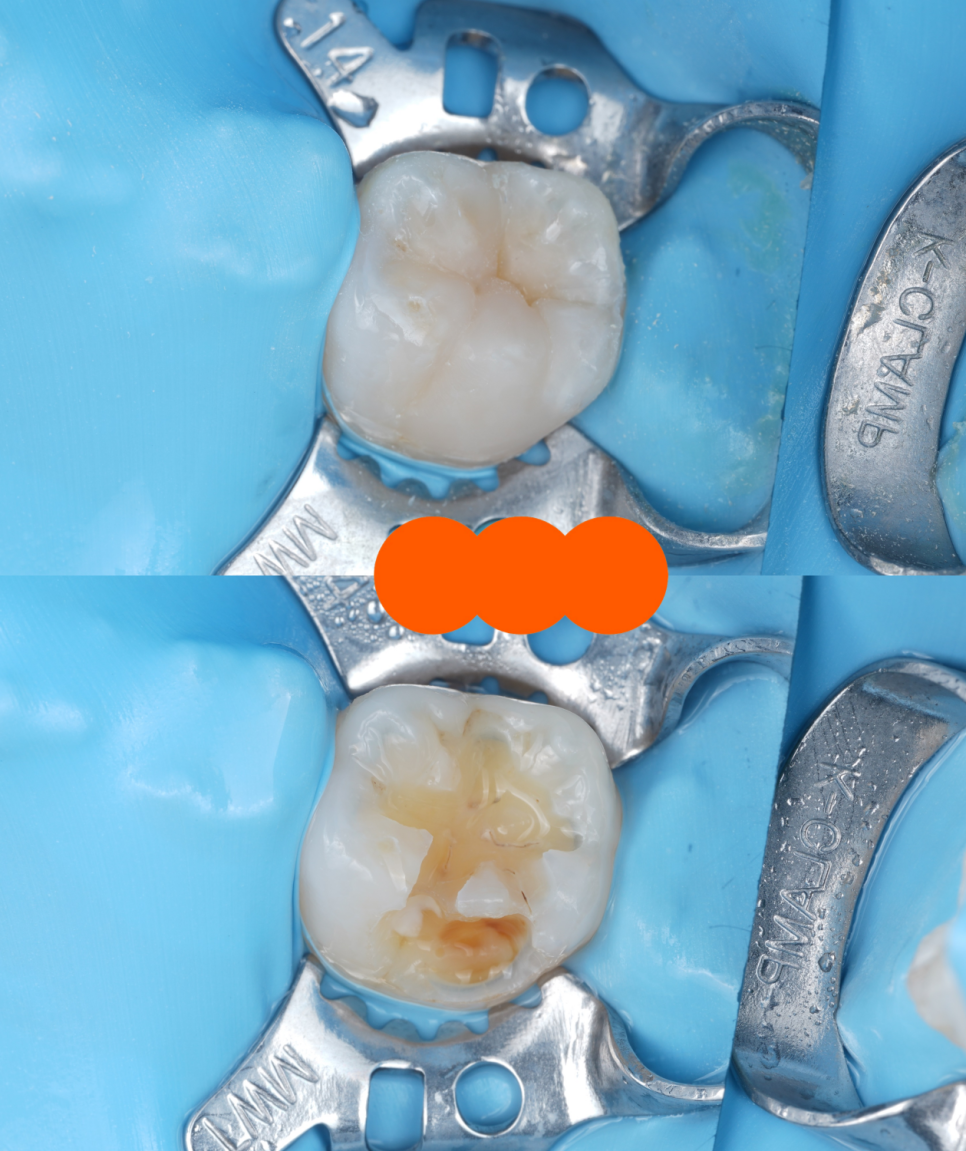 Jamnwon-dong Dental Clinic: Don’t Grind Down Your Teeth—Get Resin Build-up Instead image 10