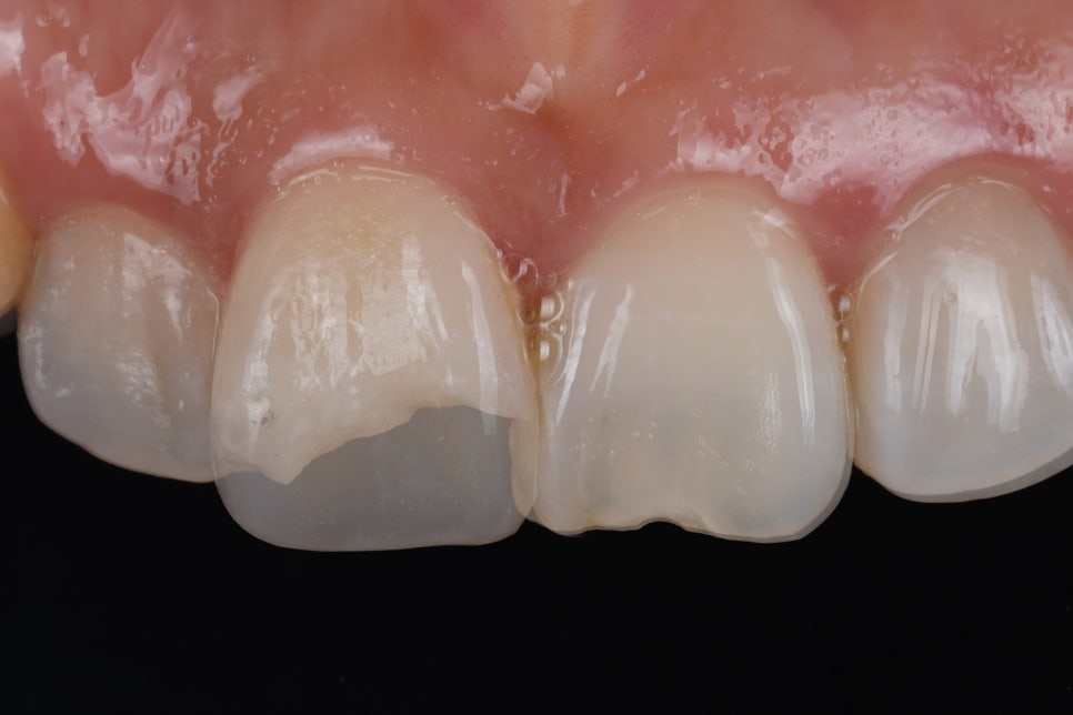 About 2 Years of Anterior Tooth Resin: 478 People, 1,038 Teeth image 1