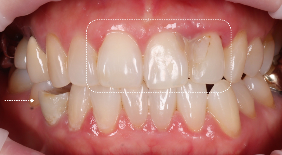 잘못된 앞니 레진 뼈까지 녹인다? 레진 재치료 과정 관련 이미지 2