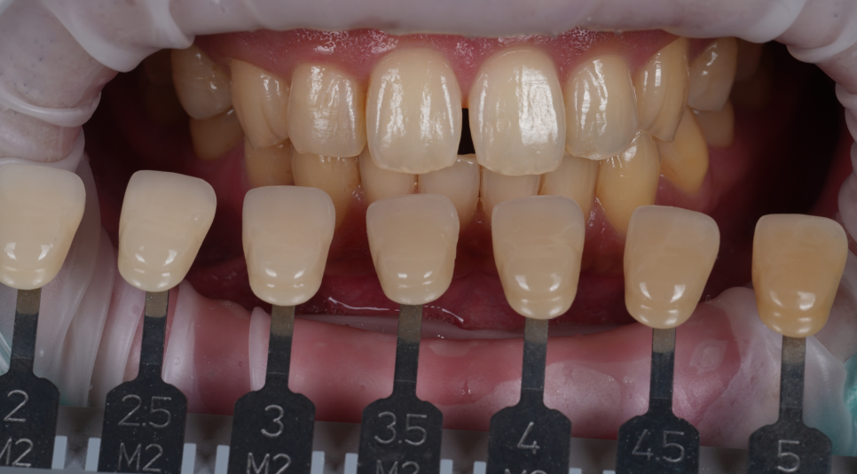 방배동치과 누렇고 벌어진 치아 미백과 레진 치료 관련 이미지 5