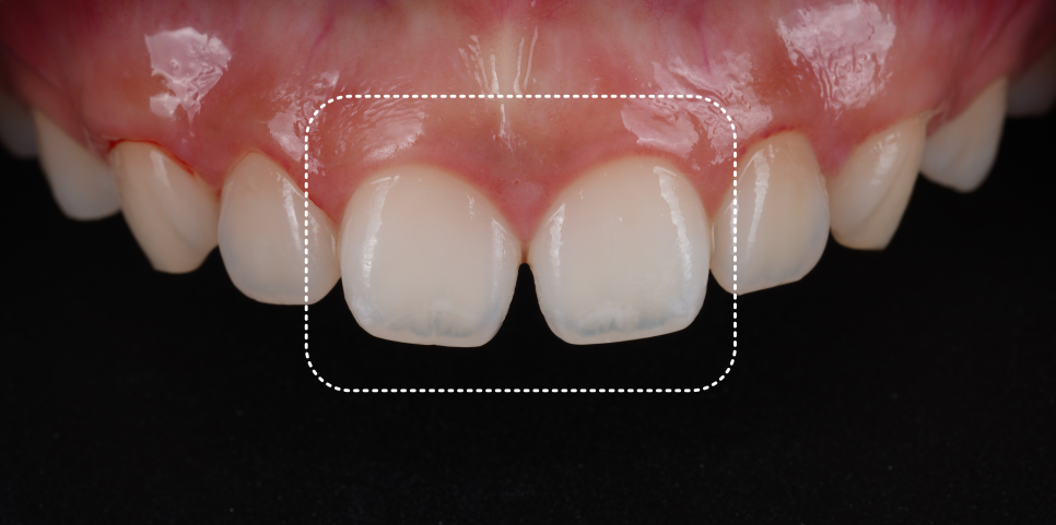 방배동치과 앞니 벌어짐 해결하러 강릉에서 오셨어요 관련 이미지 4