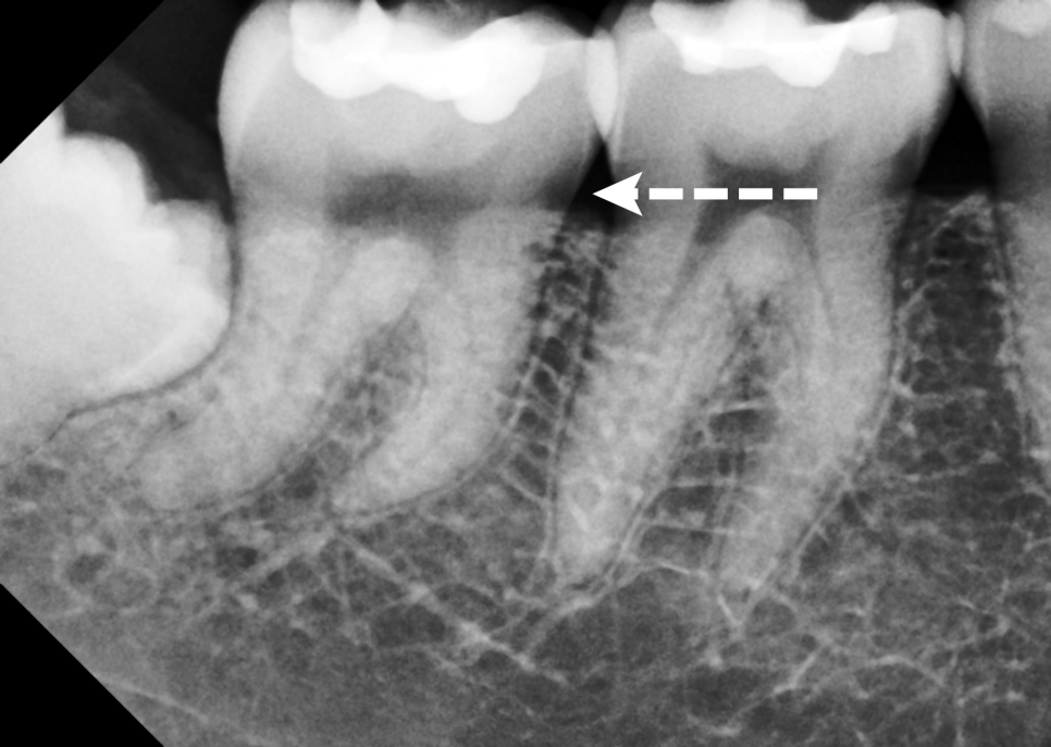 서초동치과 치아 삭제 원하지 않는다면 오버레이 하세요 관련 이미지 6