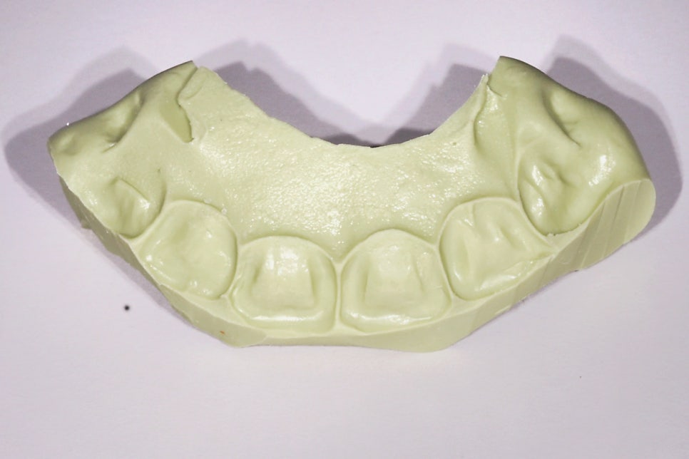 교대역, 교정 끝나고 앞니 사이 충치 레진 재치료 (유지장치 붙이기 전에 오세요) 관련 이미지 2