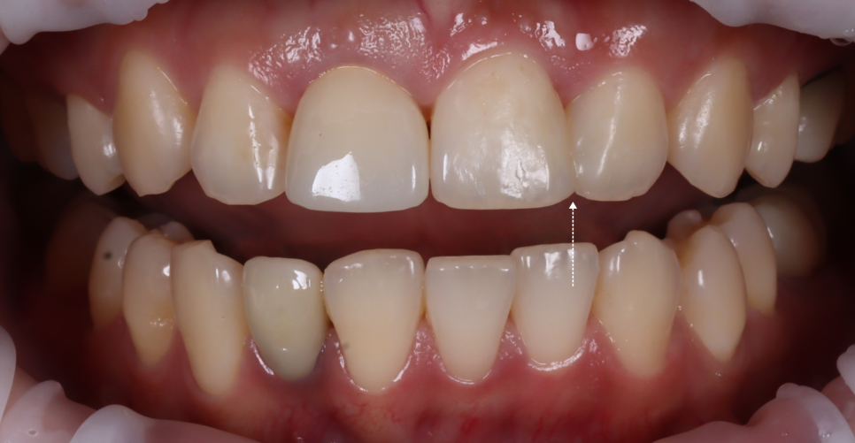서초동치과 전라도 광주에서 레진 재치료 받으러 오신 사례 관련 이미지 4