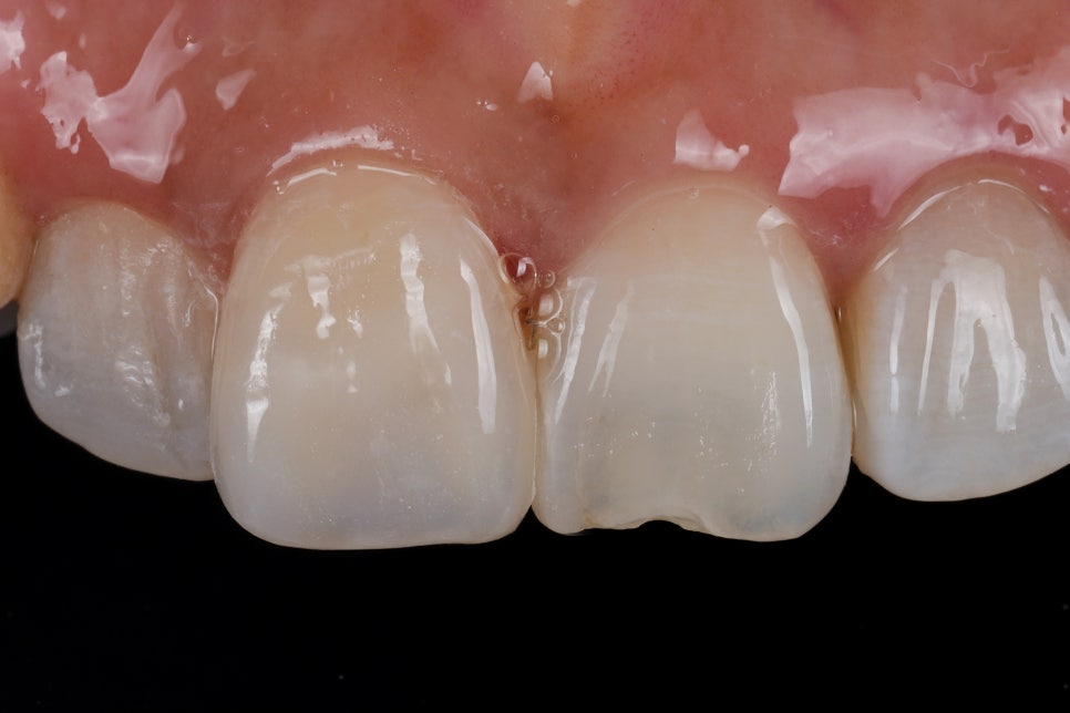 About 2 Years of Anterior Tooth Resin: 478 People, 1,038 Teeth image 2