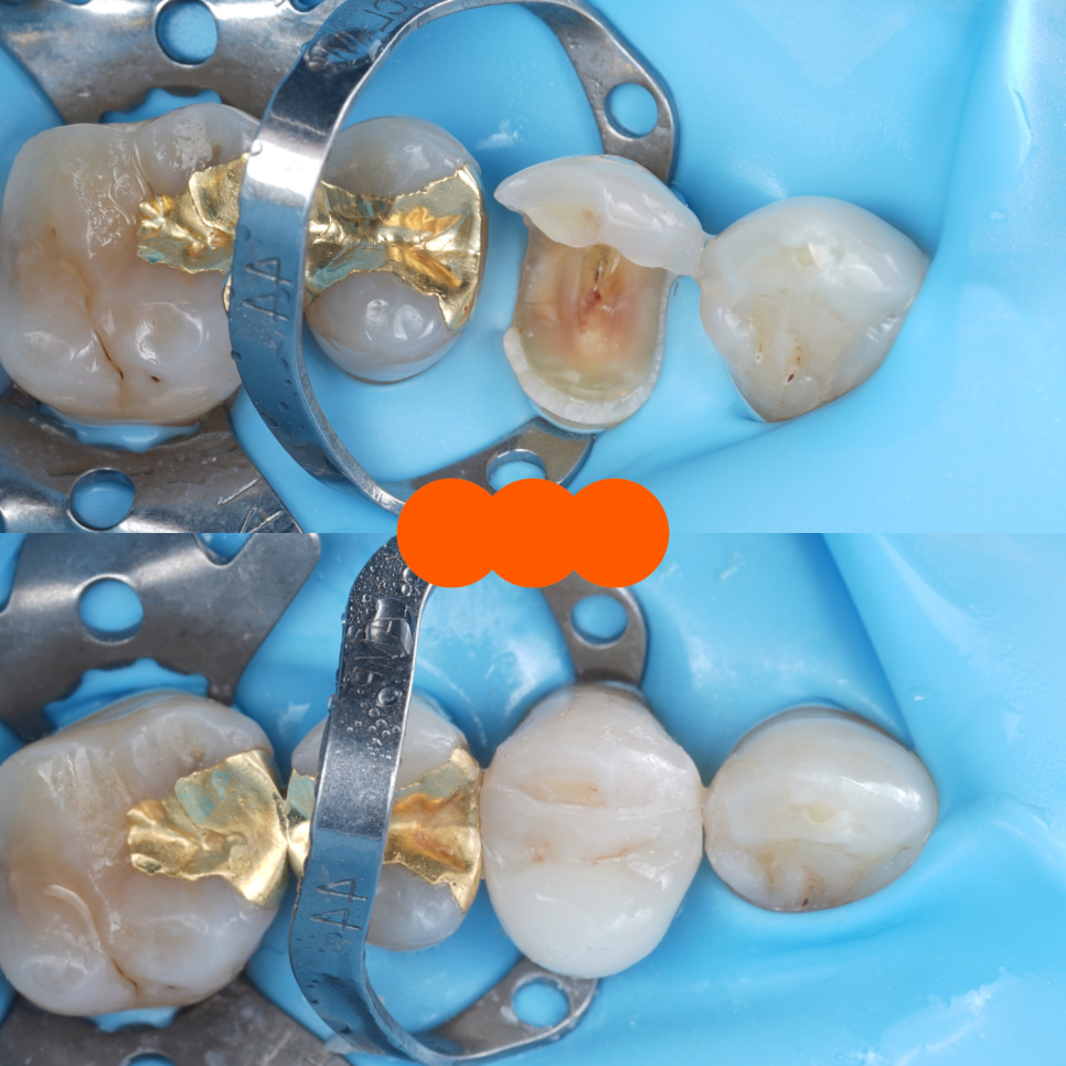 교대치과 신경치료 후 크라운 안 하고 오버레이로 보존 관련 이미지 17