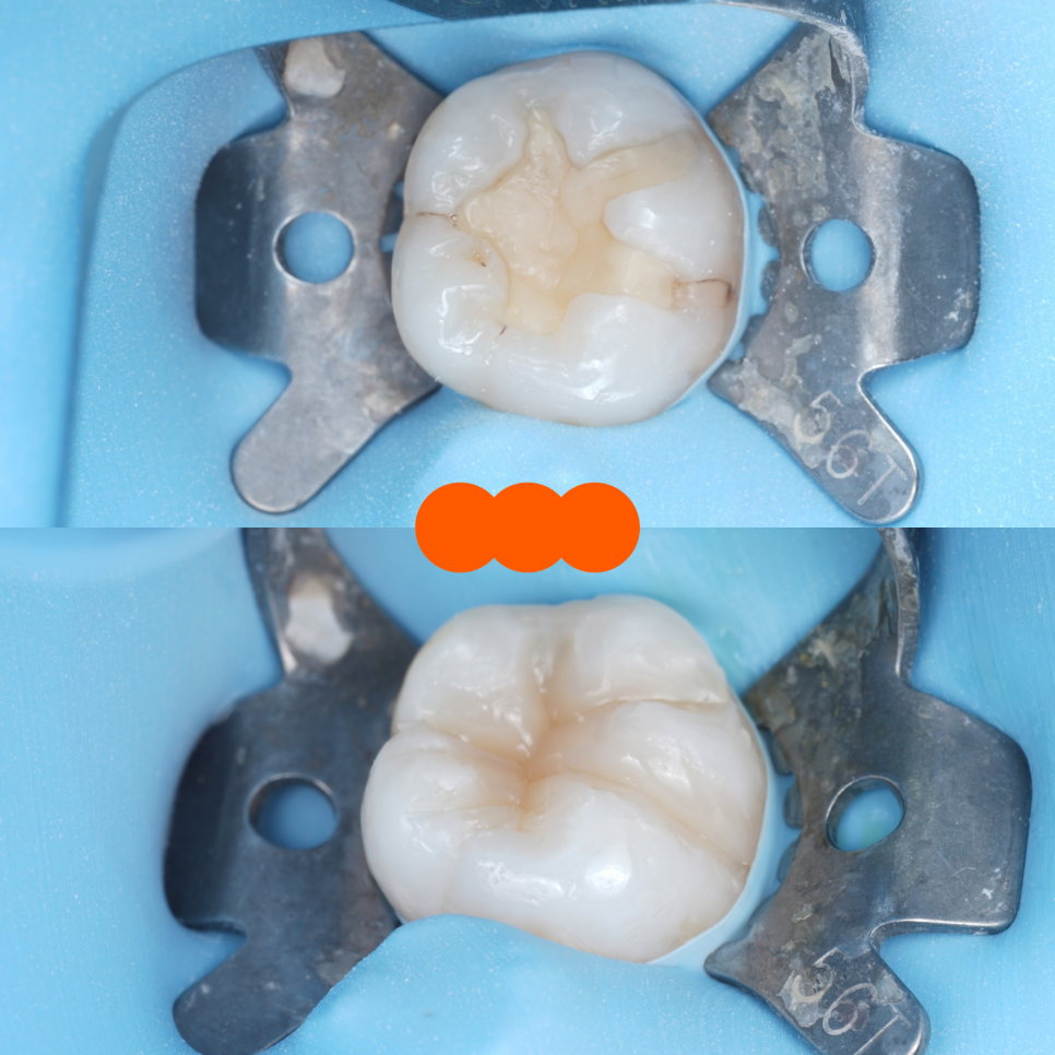 교대역치과 타치과 신경치료, 크라운 진단받았으나 레진으로 치료 관련 이미지 21