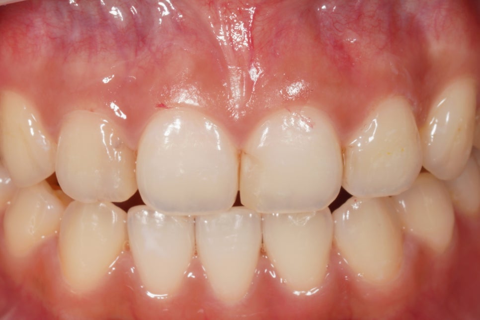 교대역, 교정 끝나고 앞니 사이 충치 레진 재치료 (유지장치 붙이기 전에 오세요) 관련 이미지 1