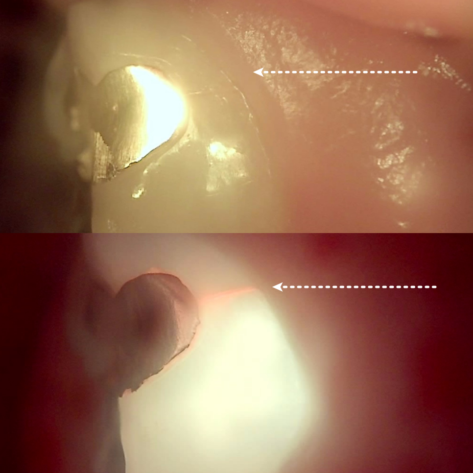 Gangnam Dental Clinic: You Wanted an Extraction, but We Preserved the Tooth with Root Canal Treatment + Overlay image 6