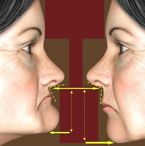 이갈이 장치 보톡스랑 함께 하면 훨씬 좋은 이유 관련 이미지 10