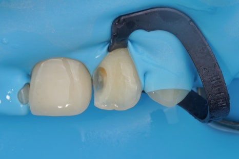 교대역 충치 치과, 신경치료 진단은 보수적으로 접근합니다. 관련 이미지 12