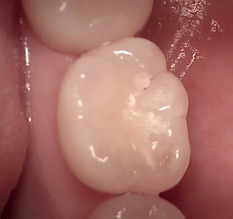 교대역 치과 보철 아래 2차 충치를 다시 레진으로 관련 이미지 17