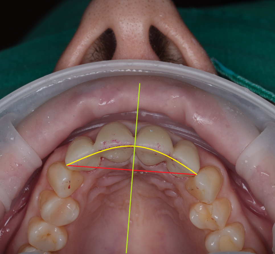 신논현치과 외국인 까만 앞니 크라운 교체 사례 관련 이미지 11