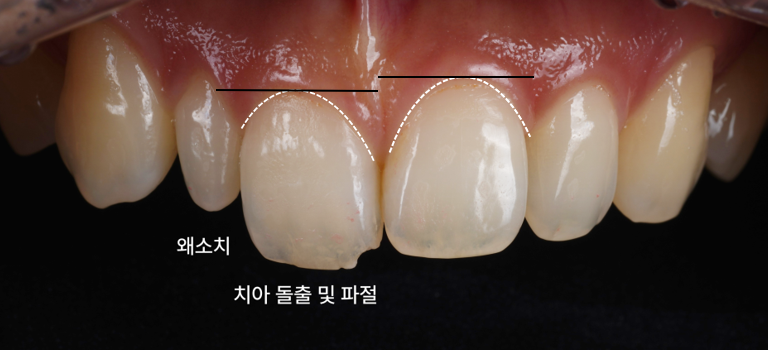 왜소치 레진으로 삭제 없이 예쁘게 관련 이미지 7