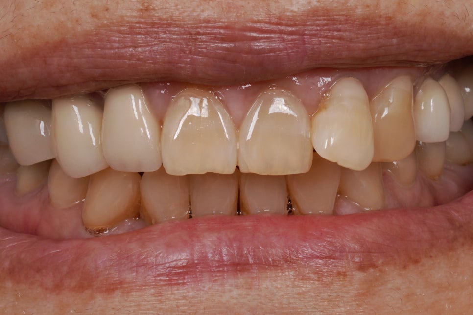 앞니 실금, 부모님 나이 든 치아 라미네이트 건강선물 관련 이미지 4