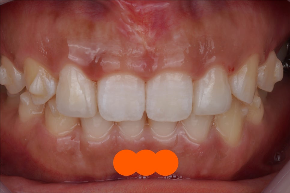 앞니 치료, 왜소치 레진은 교대역 치과에서 당일 치료받으세요 관련 이미지 2