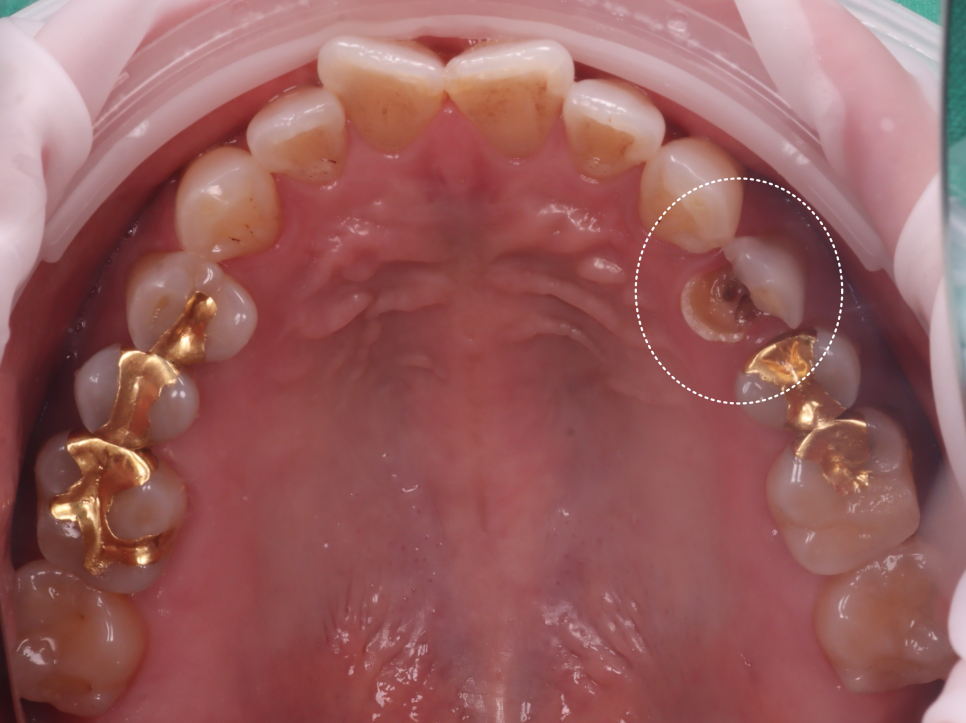 교대치과 신경치료 후 크라운 안 하고 오버레이로 보존 관련 이미지 4