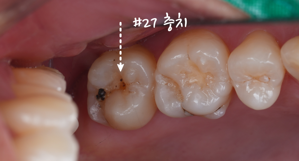 교대역치과 타치과 신경치료, 크라운 진단받았으나 레진으로 치료 관련 이미지 5