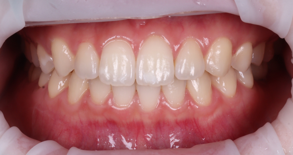 강남치과추천 앞니 하얀 반점 당일 심미 레진으로 해결 관련 이미지 2