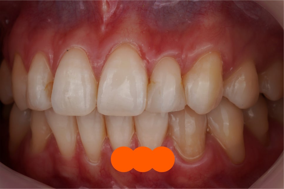 요즘 투스젬 맛집, 근데 이제 제거 맛집인- 투스젬 제거킹 재좋치 관련 이미지 8