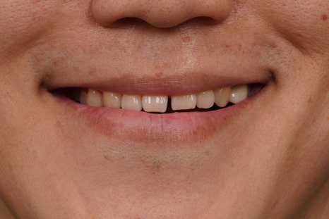 당신이 서울 교대역 재주좋은치과 라미네이트로 치료해야 하는 이유 관련 이미지 2