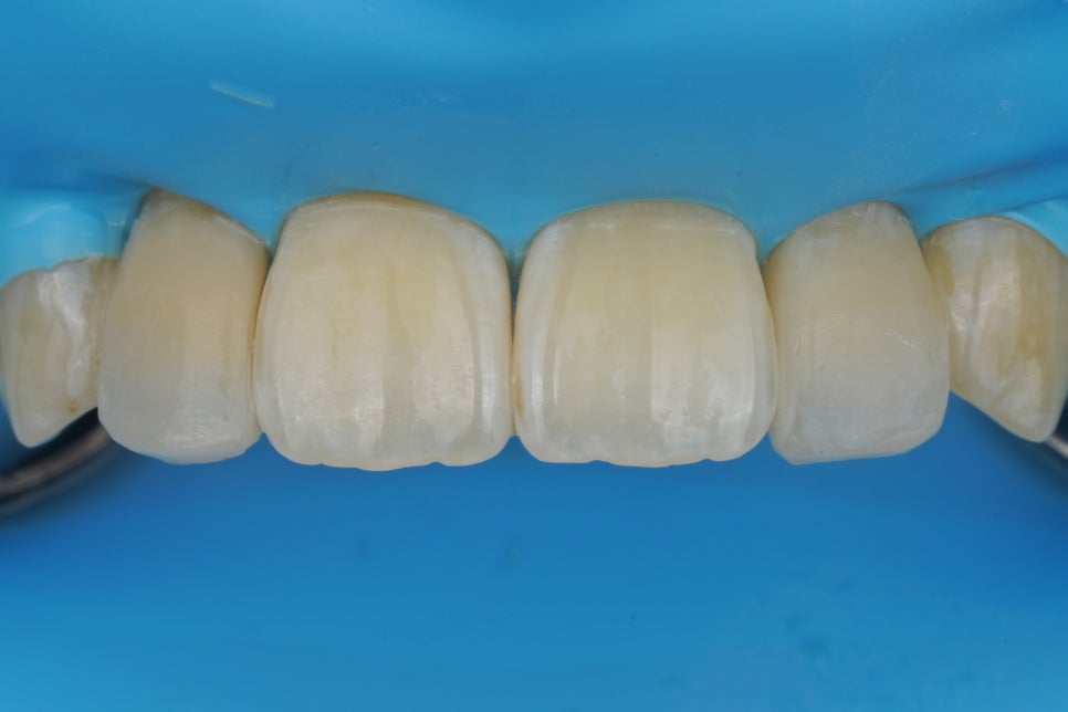 왜소치 레진, 갤럭시네이트 레진비니어로 당일 치료완료 (서초동 치과) 관련 이미지 9