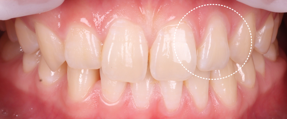 역삼역치과 벌어진 앞니 레진 이렇게 해야 진짜 티 안나요 관련 이미지 10
