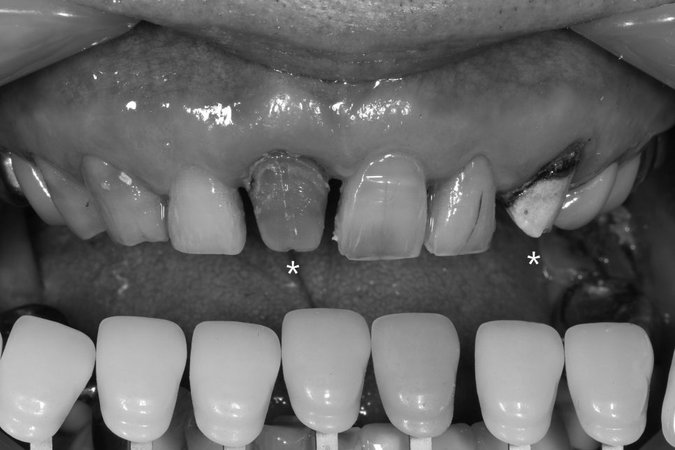 60년 전 신문배달할 때 다쳐서 씌운 앞니 크라운 변색, 지르코니아 재치료 관련 이미지 2