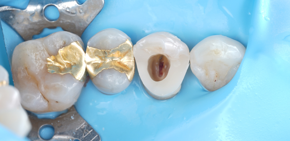 교대치과 신경치료 후 크라운 안 하고 오버레이로 보존 관련 이미지 11