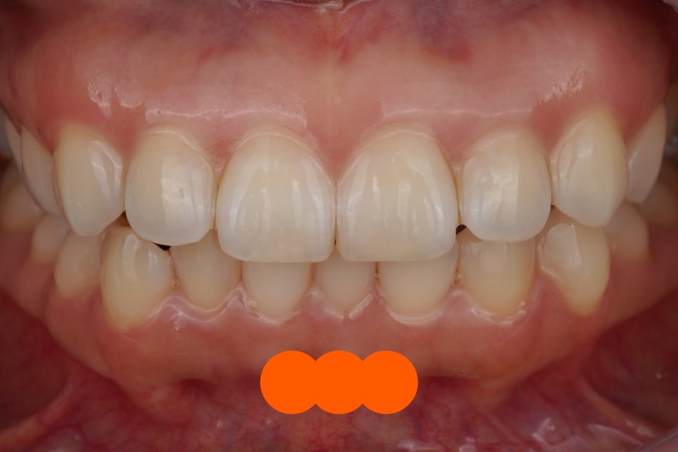 앞니 살짝 깨짐, 치아 성형으로 해결한 교대역 치과 관련 이미지 3