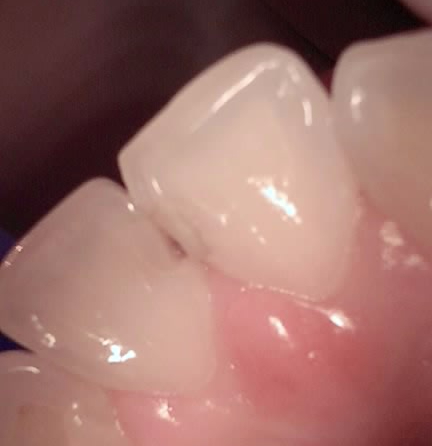 교대역 치과 보철 아래 2차 충치를 다시 레진으로 관련 이미지 5