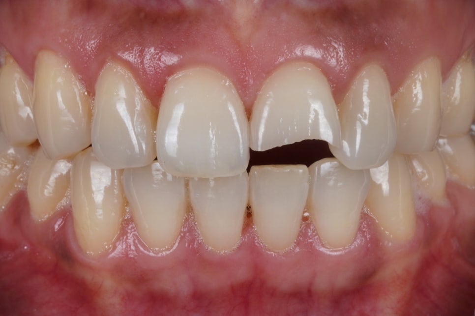 서울 앞니 레진으로 40분 안에 자연스럽게 복원한 케이스 관련 이미지 1