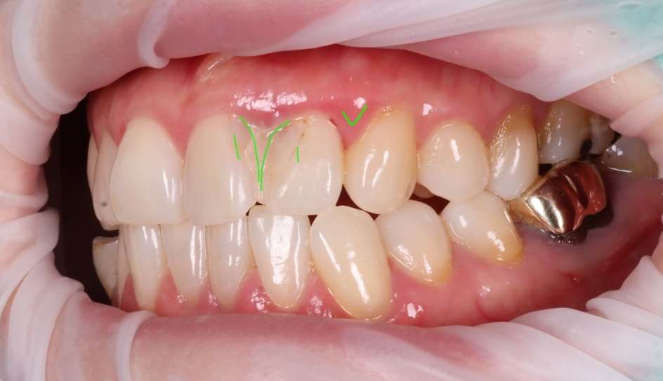 잘못된 앞니 레진 뼈까지 녹인다? 레진 재치료 과정 관련 이미지 8