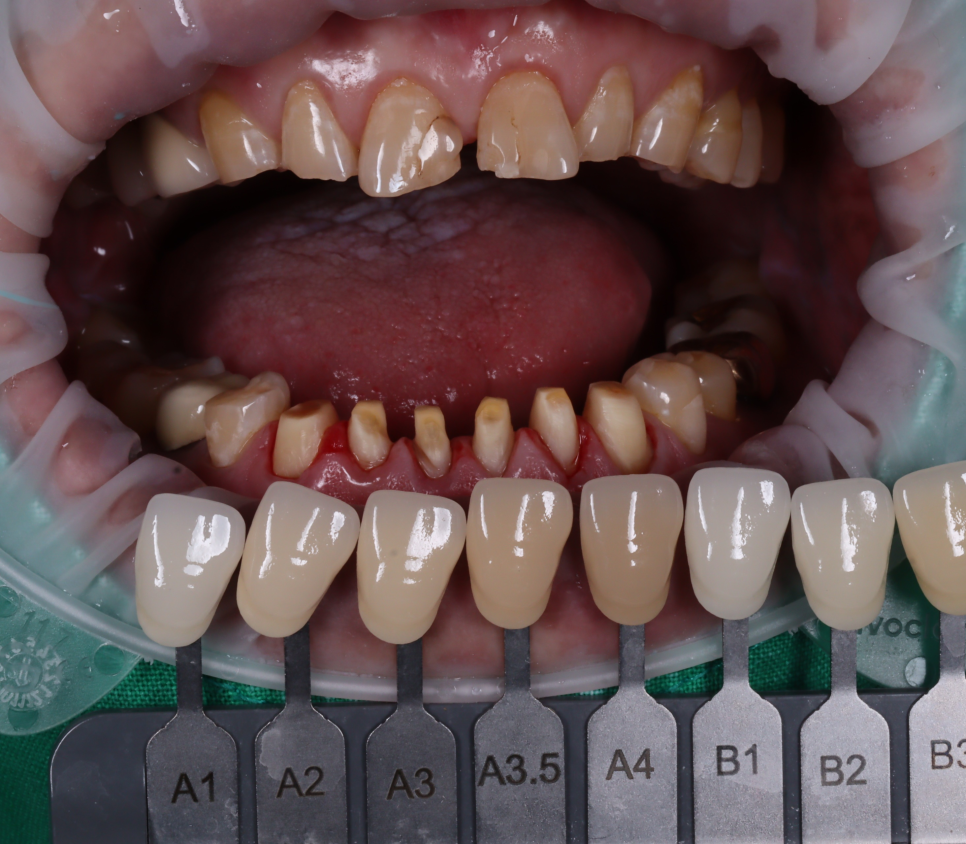신논현역치과 심하게 마모된 60대 남성 앞니 크라운 치료 관련 이미지 8