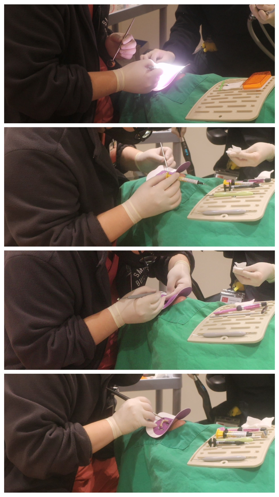 치과보존과 치아를 덜 깎는 치료를 지향하는 이유 관련 이미지 7