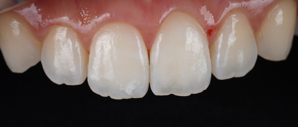 강남치과추천 앞니 하얀 반점 당일 심미 레진으로 해결 관련 이미지 7
