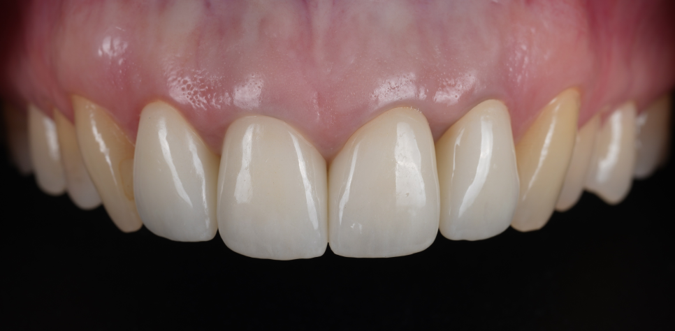 앞니 크라운 검은 선 단순한 보철 문제가 아닐 수도 있습니다 관련 이미지 7