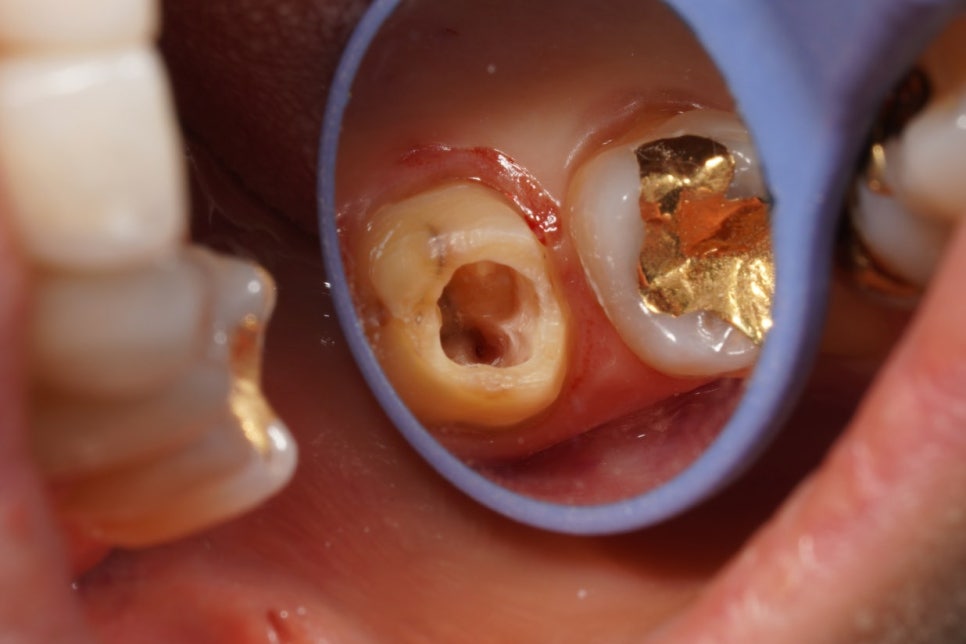 동기 치과의사의 부탁으로 어금니 신경치료만 마무리 해드린 케이스 관련 이미지 4