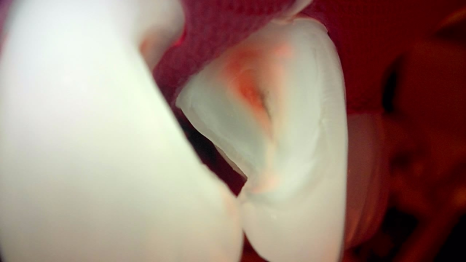 잘못된 앞니 레진 뼈까지 녹인다? 레진 재치료 과정 관련 이미지 9