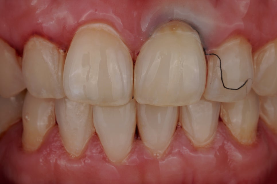 치아 패임 치경부 충치 레진 잘하는 서초동 치과 관련 이미지 4