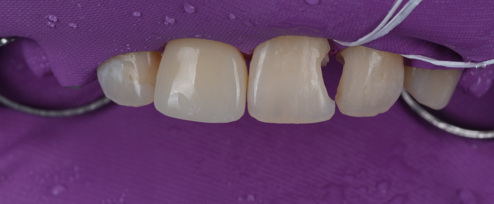 서초동치과 전라도 광주에서 레진 재치료 받으러 오신 사례 관련 이미지 7