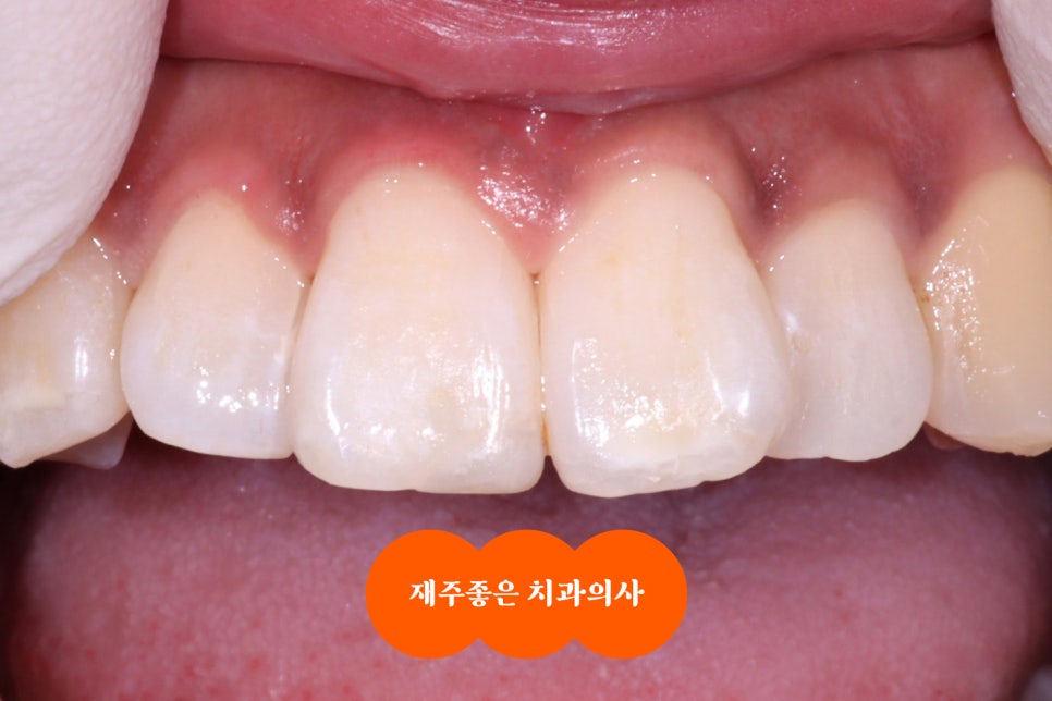 앞니 깨짐, 레진 빌드업으로 금방 다시 만들어 주기 관련 이미지 1