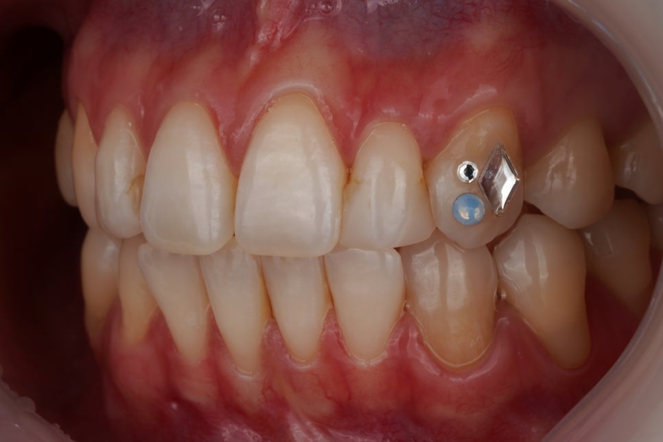 요즘 투스젬 맛집, 근데 이제 제거 맛집인- 투스젬 제거킹 재좋치 관련 이미지 7