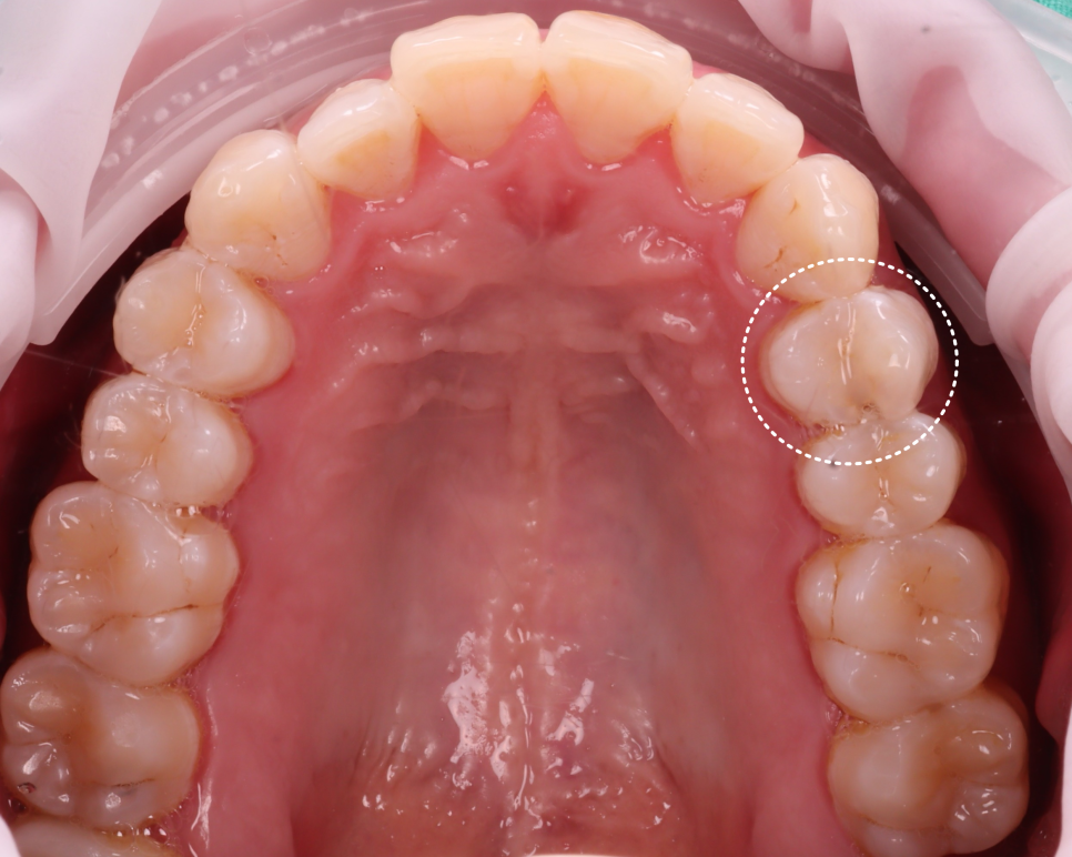 강남역치과 치료 부위 2차 충치 레진 재치료 사례 관련 이미지 3