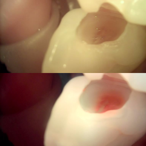 역삼역 치과 치대생 깊은 충치 신경치료없이 레진으로 완료 관련 이미지 9