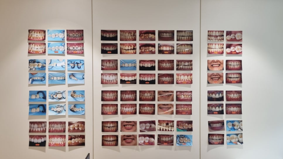 양재역치과 앞니 레진 받으러 수원에서 오신 이유(feat. 치과의사 소개) 관련 이미지 5