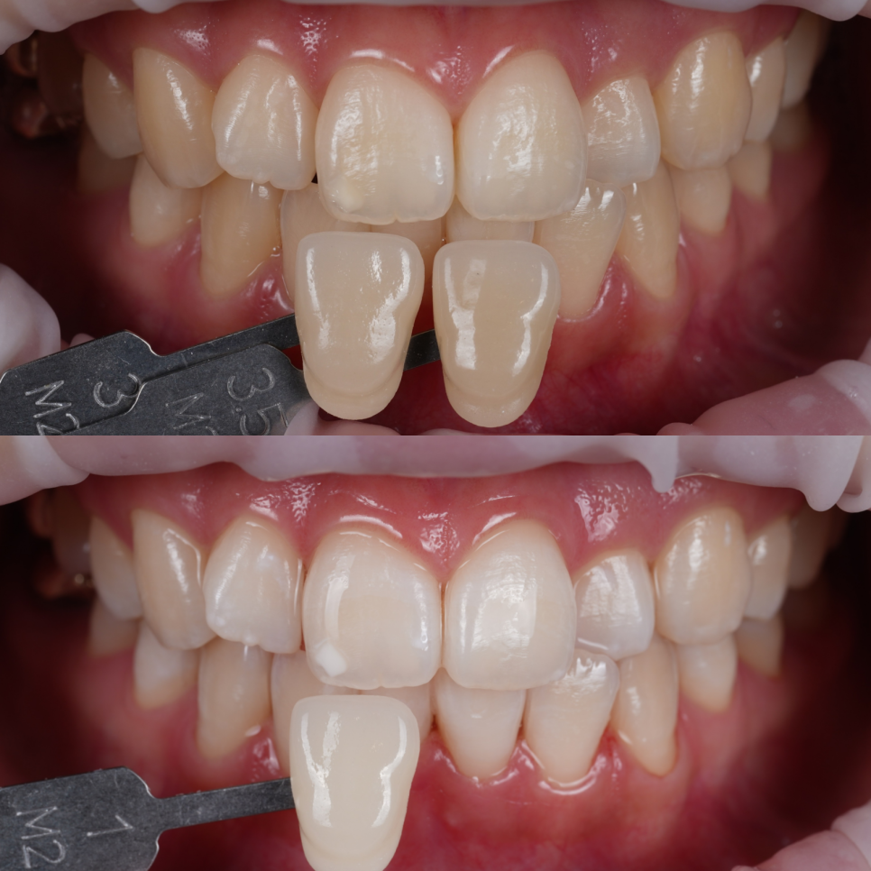 신논현치과 치아미백 누구나 예쁘게 하얗게 되는 건 아니다? 관련 이미지 8